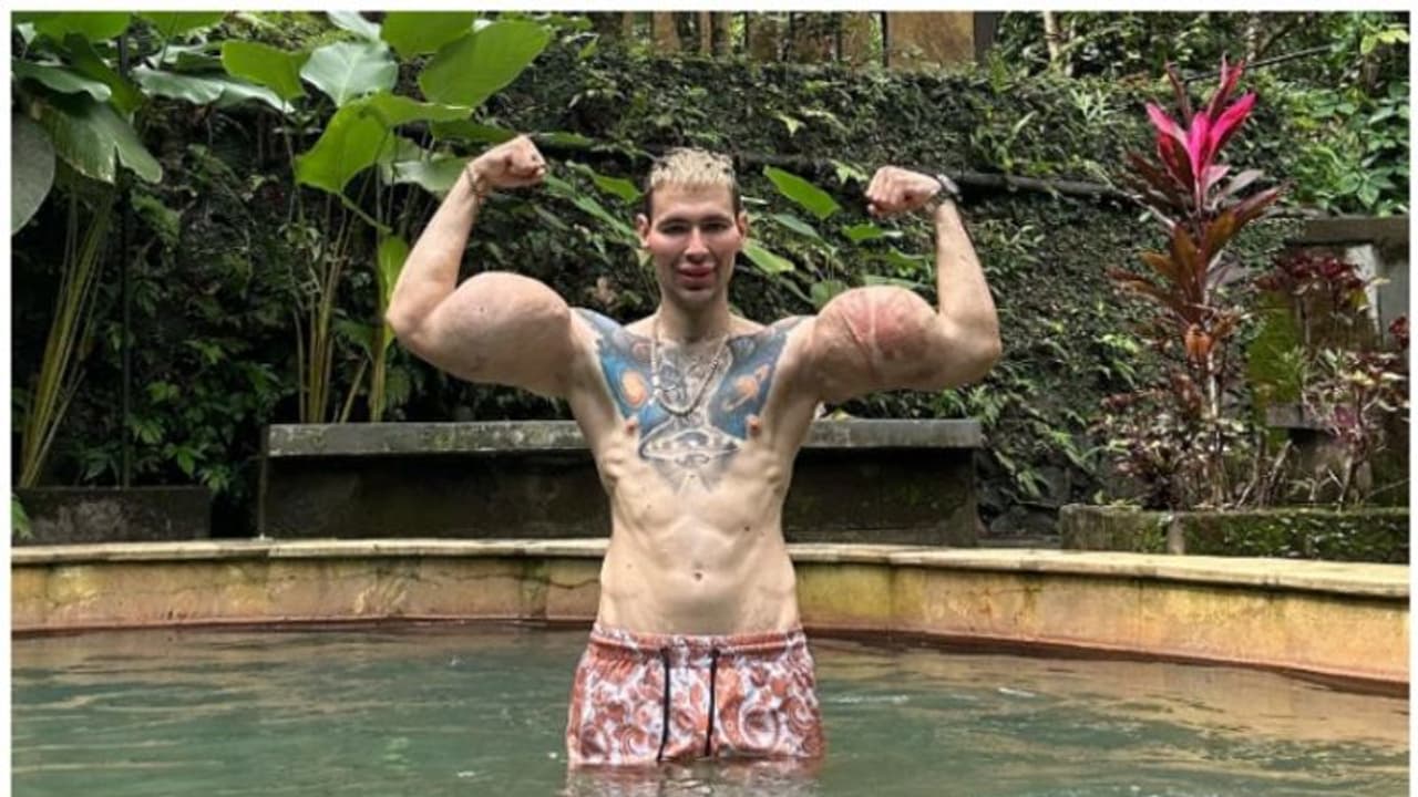 സുന്ദരികളെ ആകര്‍ഷിക്കാന്‍ കൈയില്‍ പെട്രോളിയം ജെല്ലി കുത്തിവച്ചു; പിന്നാലെ കിട്ടിയത് ‘റഷ്യൻ പോപ്പേ’ എന്ന പേര് !