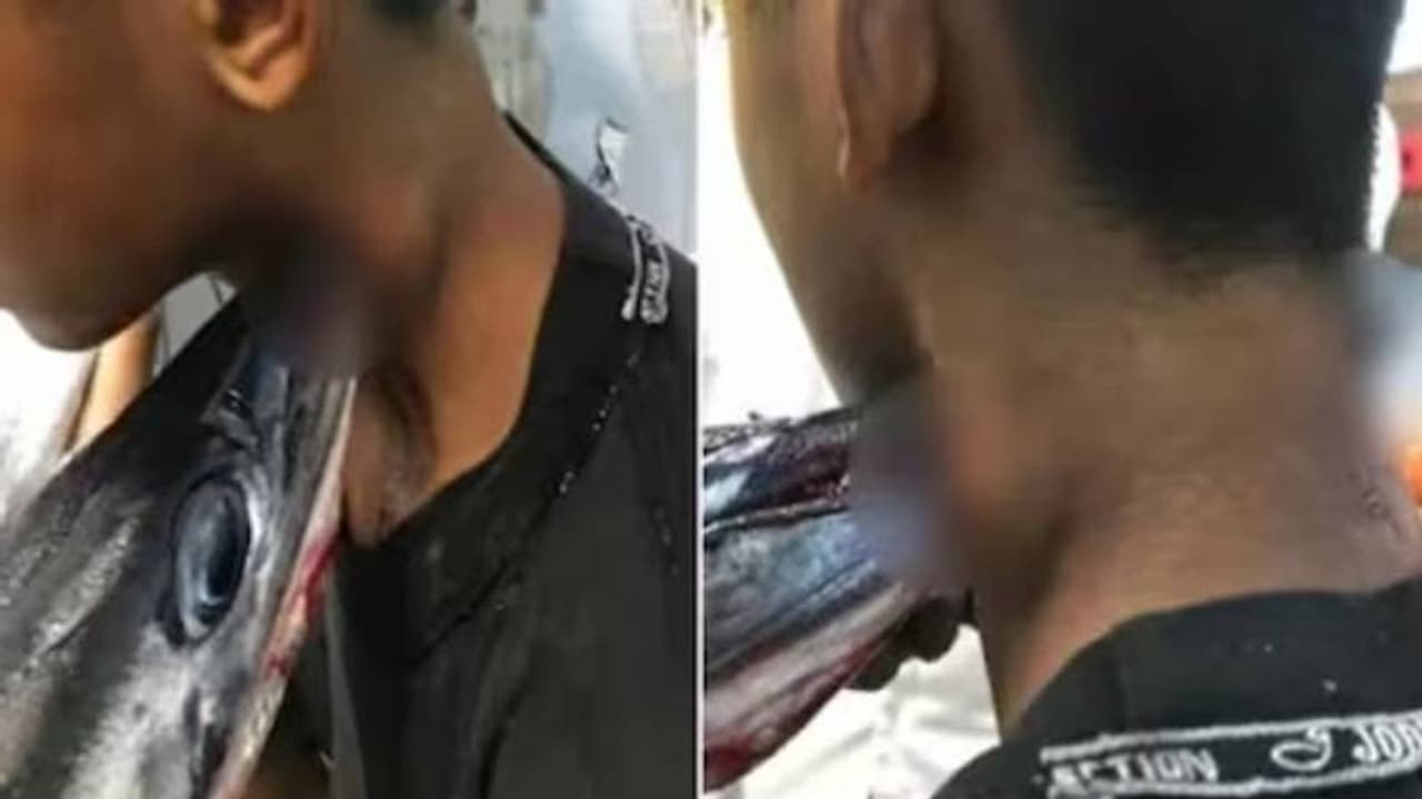 മീൻപിടിക്കാൻ പോയ യുവാവിന്റെ കഴുത്തിൽ തുളച്ചുകയറി മീൻ, നീക്കം ചെയ്യാൻ ഒരു മണിക്കൂർ നീണ്ട ശസ്ത്രക്രിയ മീൻപിടിക്കാൻ പോയ യുവാവിന്റെ കഴുത്തിൽ തുളച്ചുകയറി മീൻ, നീക്കം ചെയ്യാൻ ഒരു മണിക്കൂർ നീണ്ട ശസ്ത്രക്രിയ