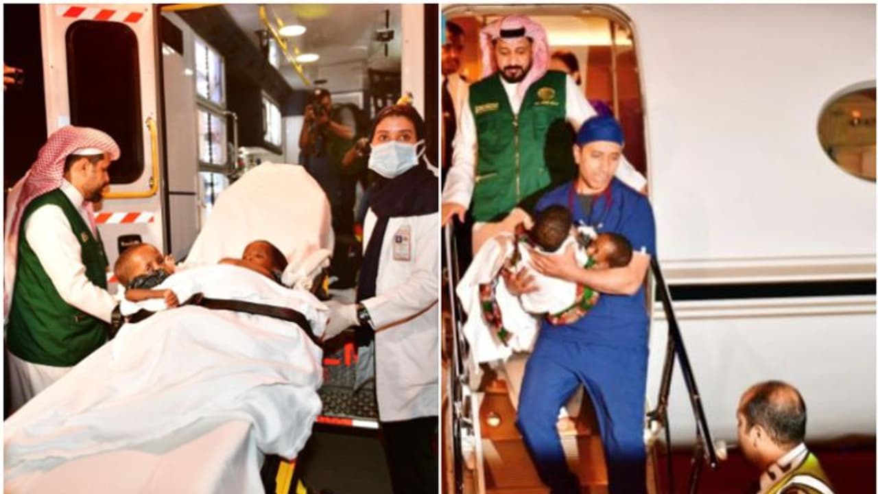 വേർപെടുത്തൽ ശസ്ത്രക്രിയക്കായി താൻസാനിയൻ സയാമീസ് ഇരട്ടകളെ റിയാദിലെത്തിച്ചു വേർപെടുത്തൽ ശസ്ത്രക്രിയക്കായി താൻസാനിയൻ സയാമീസ് ഇരട്ടകളെ റിയാദിലെത്തിച്ചു