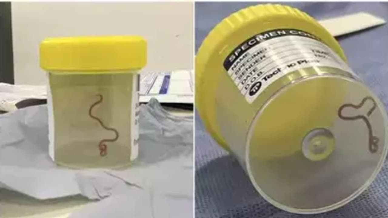 സ്ത്രീയുടെ തലച്ചോറില് നിന്നും ജീവനുള്ള വിരയെ കണ്ടെത്തി; ഇത് ഞെട്ടിക്കുന്ന അനുഭവം സ്ത്രീയുടെ തലച്ചോറില് നിന്നും ജീവനുള്ള വിരയെ കണ്ടെത്തി; ഇത് ഞെട്ടിക്കുന്ന അനുഭവം