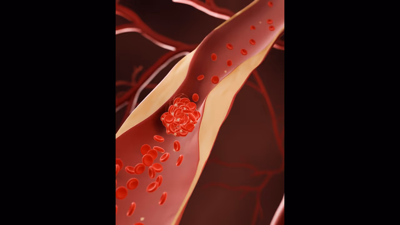 ഉയർന്ന കൊളസ്ട്രോൾ ; ശരീരം കാണിക്കുന്ന ഈ ലക്ഷണങ്ങൾ അവഗണിക്കരുത്