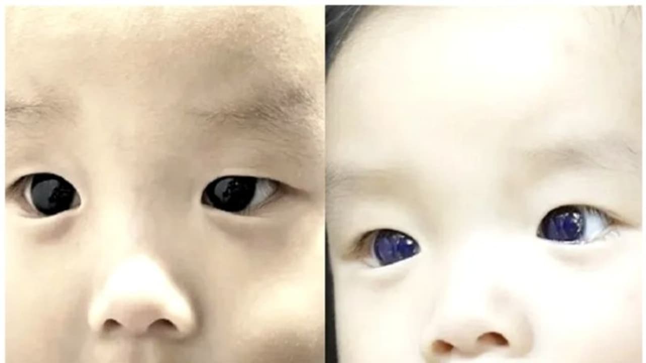 കോവിഡ് പ്രതിരോധ ചികിത്സ; ആറുമാസം പ്രായമുള്ള കുഞ്ഞിന്‍റെ കണ്ണുകളുടെ നിറം മാറി ! 
