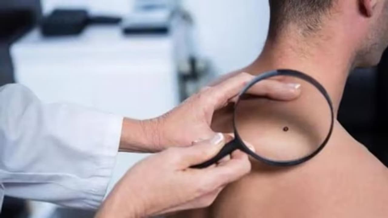 മെലനോമ; അറിയാം കാരണങ്ങൾ, ലക്ഷണങ്ങൾ, പ്രതിരോധം... മെലനോമ; അറിയാം കാരണങ്ങൾ, ലക്ഷണങ്ങൾ, പ്രതിരോധം...