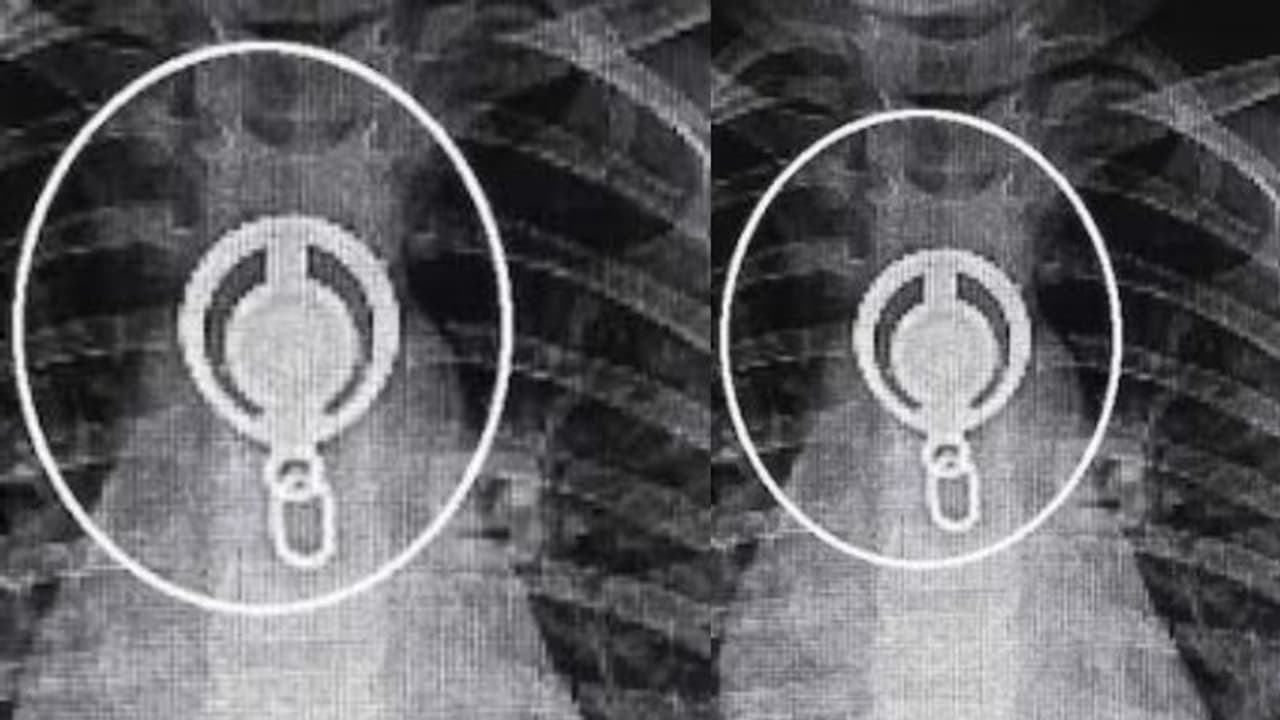 കട്ടപ്പനയിൽ 3 വയസ്സുകാരി ലോക്കറ്റ് വിഴുങ്ങി, അന്നനാളത്തിൽ കുടുങ്ങി; ശസ്ത്രക്രിയ കൂടാതെ പുറത്തെടുത്ത് ഡോക്ടർമാർ കട്ടപ്പനയിൽ 3 വയസ്സുകാരി ലോക്കറ്റ് വിഴുങ്ങി, അന്നനാളത്തിൽ കുടുങ്ങി; ശസ്ത്രക്രിയ കൂടാതെ പുറത്തെടുത്ത് ഡോക്ടർമാർ