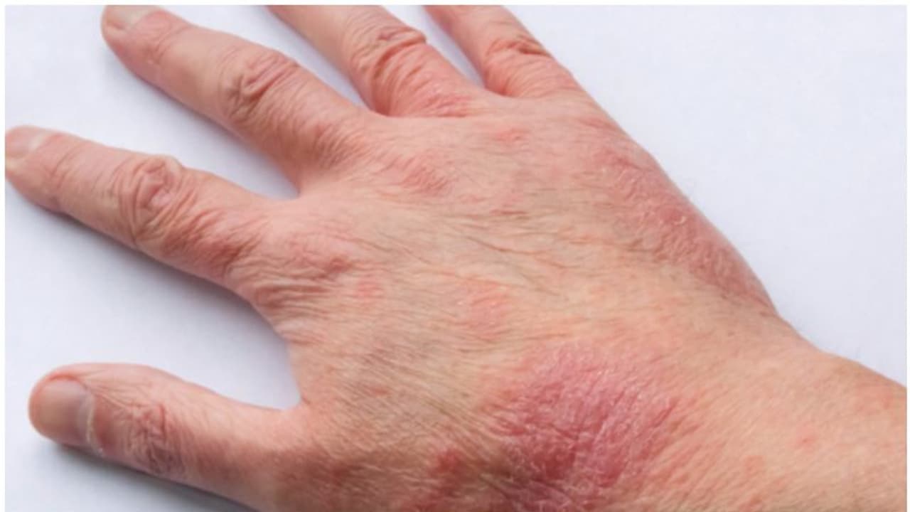  10,000 ത്തിലധികം കേസുകളും ബാധിച്ചത് 12 വയസിന് താഴെയുള്ള കുട്ടികളിൽ; അറ്റോപിക് എക്‌സിമ അറിയിപ്പുമായി കുവൈത്ത്