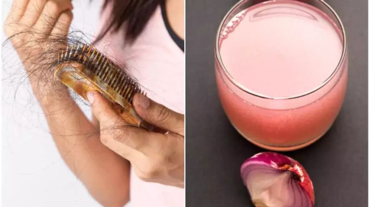 തലമുടി കൊഴിച്ചിലും താരനും അകറ്റാന്‍ പരീക്ഷിക്കാം ഉള്ളി കൊണ്ടുള്ള ഹെയര്‍ പാക്കുകള്‍... 