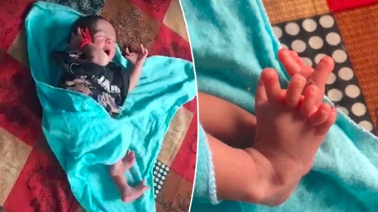 26 ಬೆರಳುಗಳಿರುವ ಹೆಣ್ಣು ಮಗು ಜನನ: ಲಕ್ಷ್ಮಿಯ ಪ್ರತಿರೂಪವೆಂದ ಕುಟುಂಬ