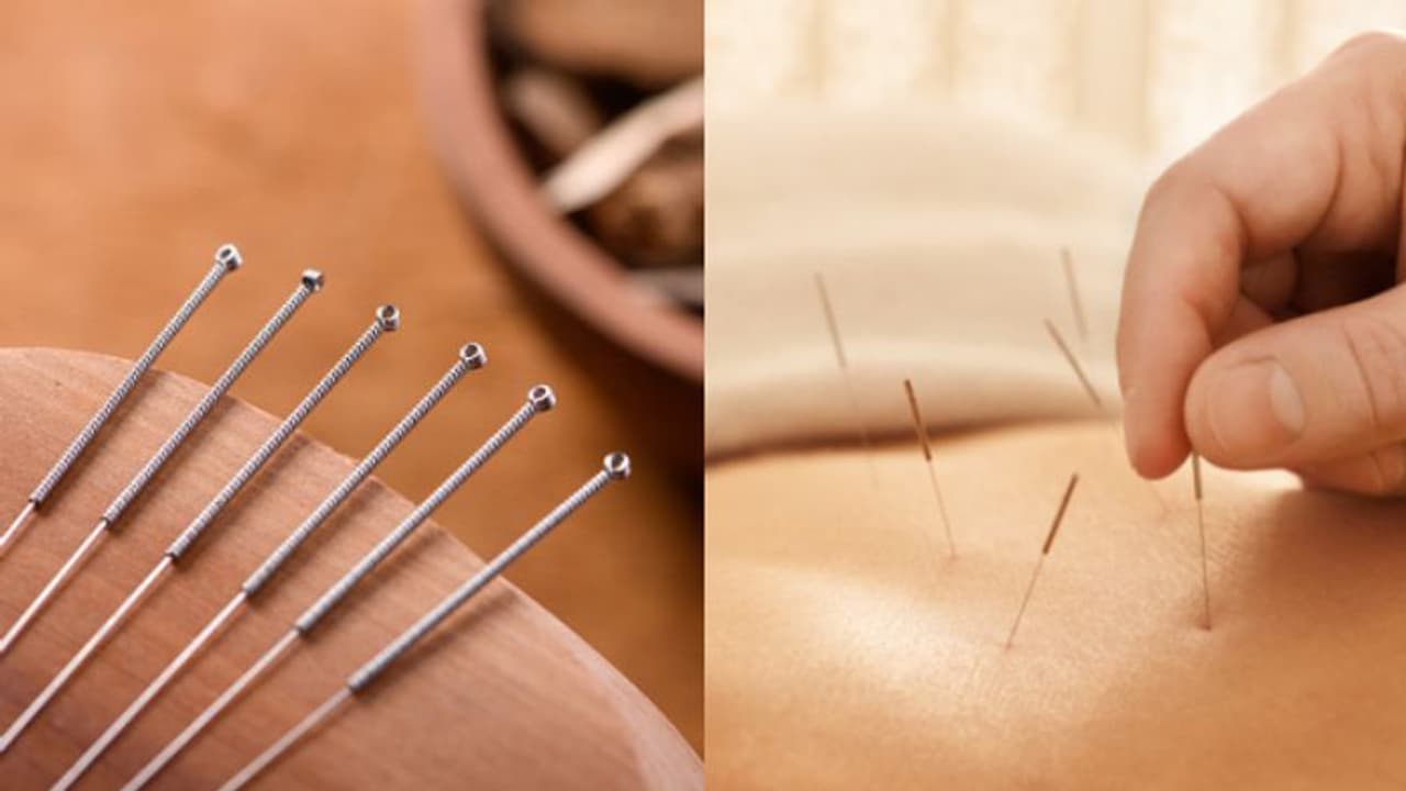 അക്യുപങ്ചര്‍ സൂചി ഉപയോഗിച്ചതിലെ പിഴവ്, ശ്വാസകോശം ചുരുങ്ങി കുഴഞ്ഞ് വീണ് 63കാരി ഗുരുതരാവസ്ഥയിൽ, കേസ് 