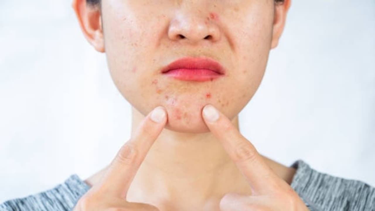 കൊളസ്ട്രോള്‍ കൂടുമ്പോള്‍ മുഖത്ത് പ്രകടമാകുന്ന ലക്ഷണങ്ങള്‍ അറിയാം...