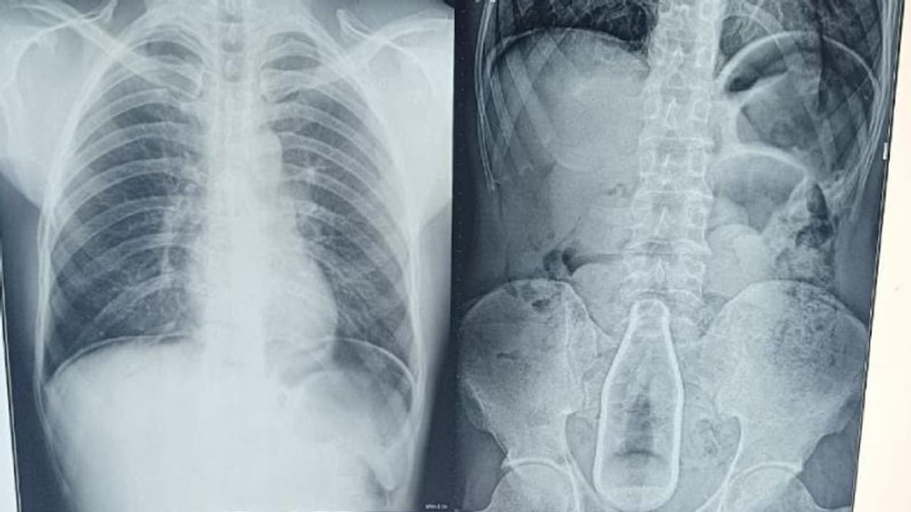 வெளியேறிய ரத்தம்.. நபரின் வயிற்றில் இருந்த குளிர்பான பாட்டில்.. எப்படி உள்ளே சென்றது? வெளியான அதிர்ச்சி தகவல்!