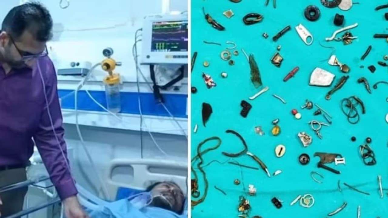 കടുത്ത വയറുവേദന; ഒടുവില്‍ ശസ്ത്രക്രിയയിലൂടെ വയറ്റിനുള്ളില്‍ നിന്ന് പുറത്തെടുത്തത് കണ്ടോ