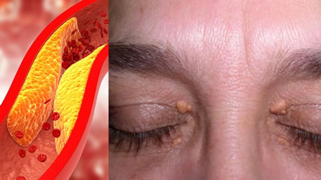 ചീത്ത കൊളസ്‌ട്രോള്‍ ഉണ്ടോ? ശരീരം പ്രകടമാക്കുന്ന ഈ ലക്ഷണങ്ങള്‍ അറിയാതെ പോകരുതേ...