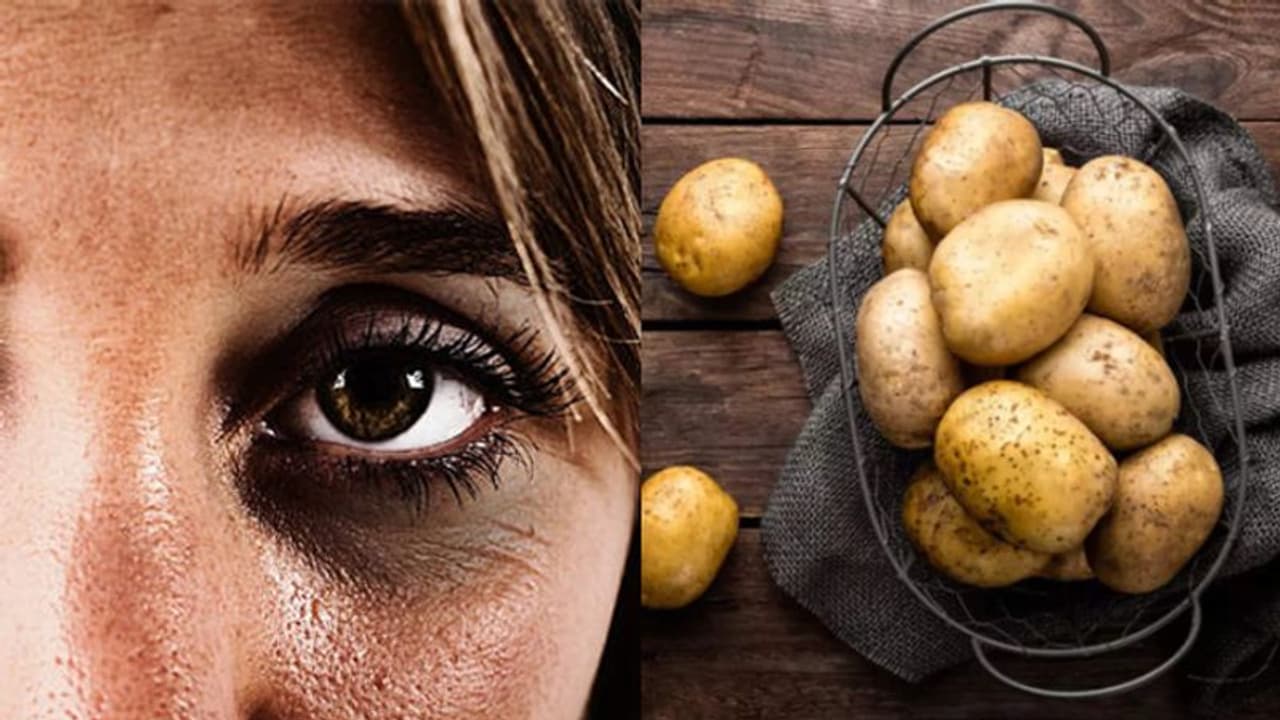 കണ്ണിന് ചുറ്റുമുള്ള കറുത്ത പാടുകള്‍ മാറ്റാന്‍ ഉരുളക്കിഴങ്ങ് ഇങ്ങനെ ഉപയോഗിക്കൂ... 