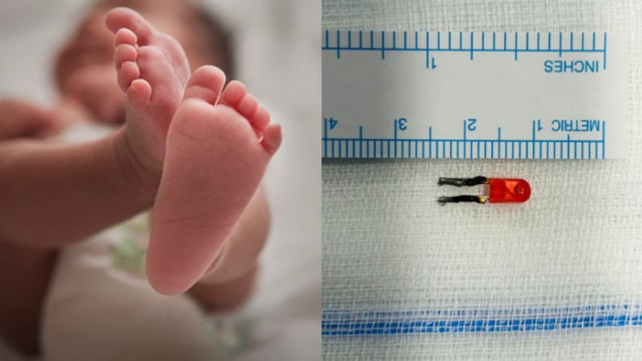 షాకింగ్.. ఏడునెలల చిన్నారి ఊపిరితిత్తుల్లో ఒకటిన్నర సెంటీమీటర్ల ఎల్ఈడి బల్బు..