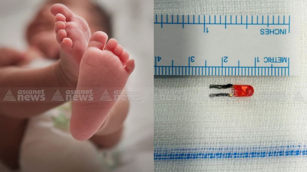 നിലയ്ക്കാത്ത ചുമയും ശ്വാസ തടസവും, കൊച്ചിയിൽ 7 മാസം പ്രായമുള്ള ആൺകുട്ടിയുടെ ശ്വാസകോശത്തിൽ കണ്ടത് എൽഇഡി ബൾബ്