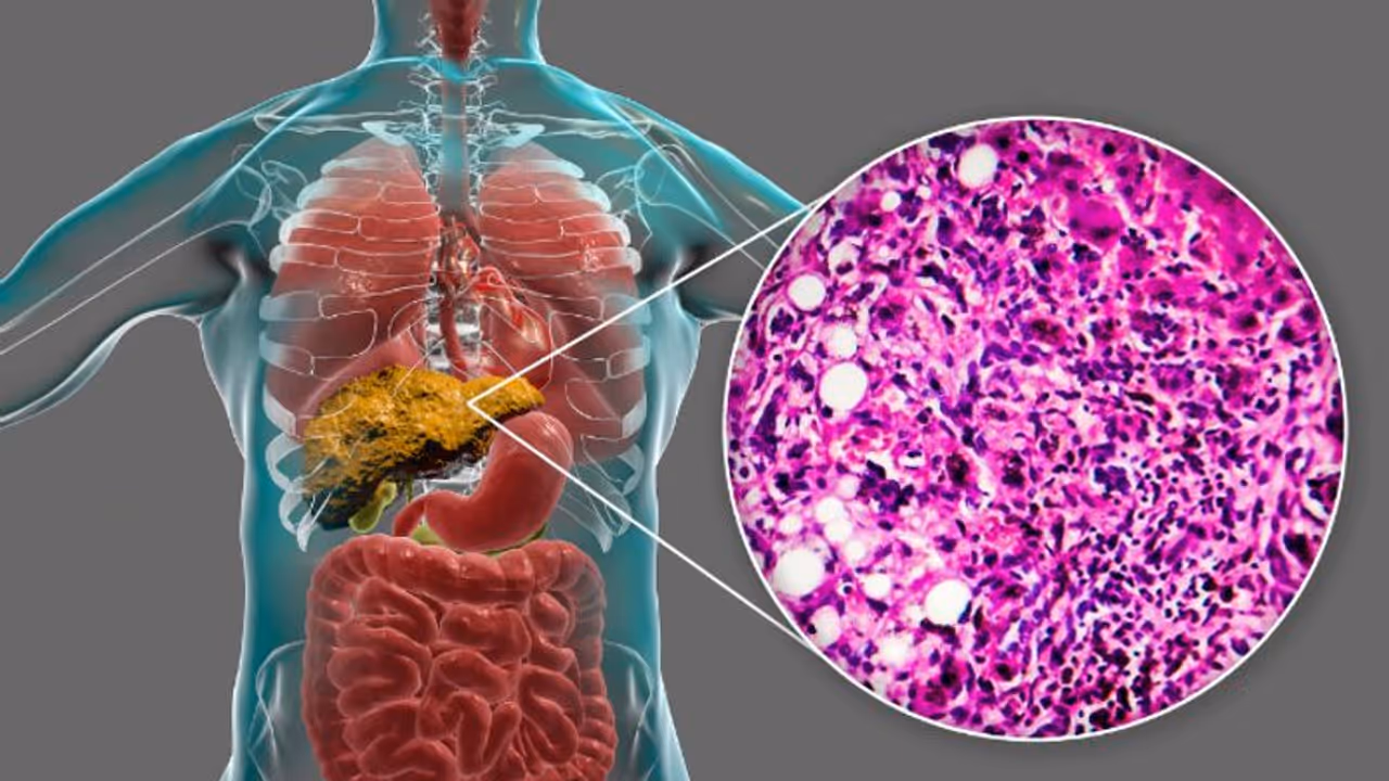 ഇവ കഴിച്ചോളൂ, ഫാറ്റി ലിവർ തടയാം ഇവ കഴിച്ചോളൂ, ഫാറ്റി ലിവർ തടയാം