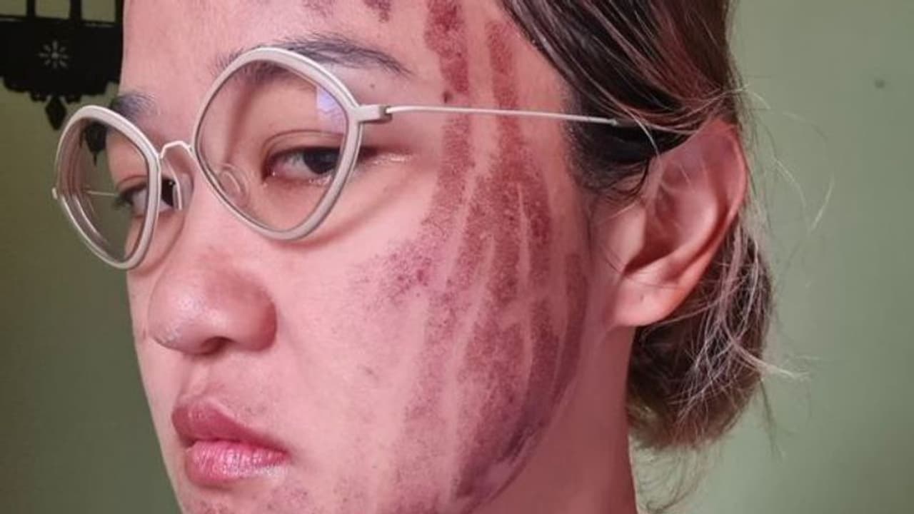 ಲೇಸರ್ ಫೇಶಿಯಲ್ ಎಫೆಕ್ಟ್: ಸೀದೋದ ದೋಸೆಯಂತಾಯ್ತು ಮುದ್ದಾದ ಯುವತಿ ಮುಖ ಲೇಸರ್ ಫೇಶಿಯಲ್ ಎಫೆಕ್ಟ್: ಸೀದೋದ ದೋಸೆಯಂತಾಯ್ತು ಮುದ್ದಾದ ಯುವತಿ ಮುಖ