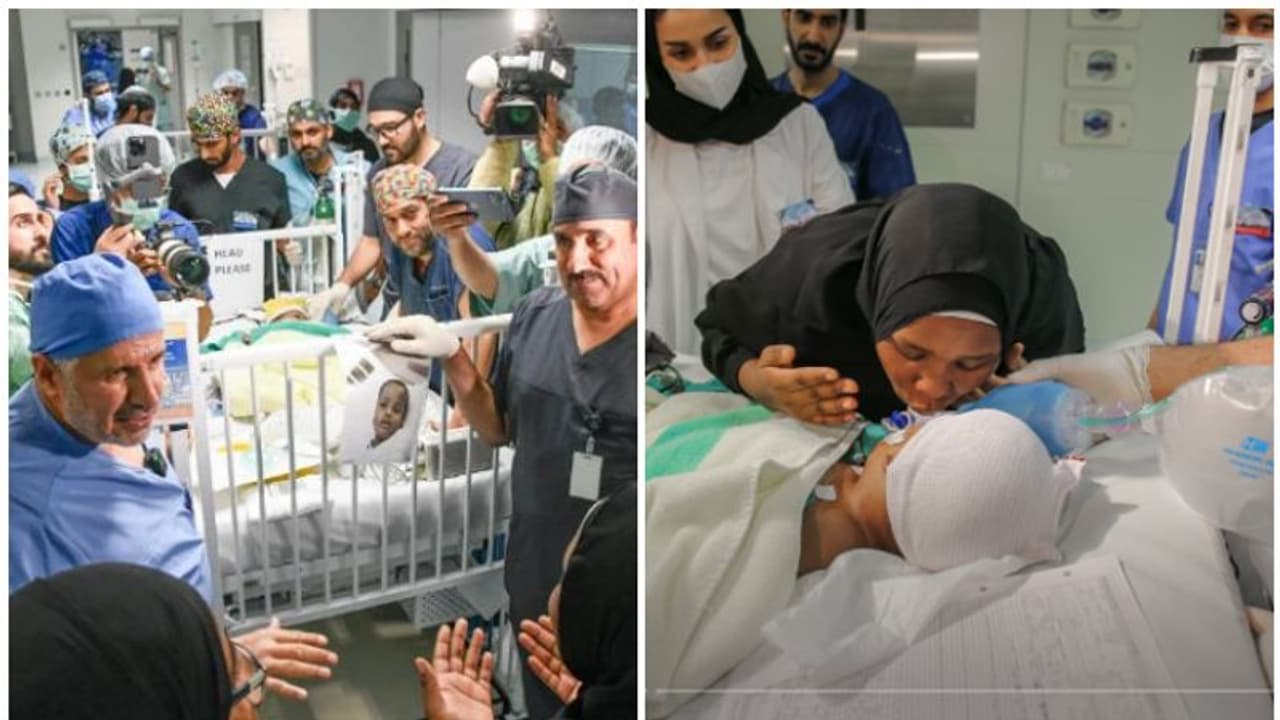 16 മണിക്കൂർ നീണ്ട ശസ്ത്രക്രിയ; സയാമീസ് ഇരട്ടകളെ വേർപ്പെടുത്തി; ഇരുമെയ്യായി ഹസ്സനും ഹുസൈനും