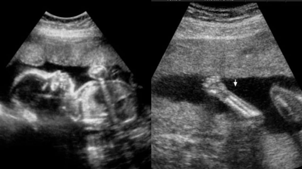 കാലുകളില്ലാത്ത ഗർഭസ്ഥ ശിശുവിന്റെ തുടയെല്ലിന്റെ നീളമടക്കം രേഖപ്പെടുത്തി ആശുപത്രി, 82 ലക്ഷം നഷ്ടപരിഹാരം കാലുകളില്ലാത്ത ഗർഭസ്ഥ ശിശുവിന്റെ തുടയെല്ലിന്റെ നീളമടക്കം രേഖപ്പെടുത്തി ആശുപത്രി, 82 ലക്ഷം നഷ്ടപരിഹാരം