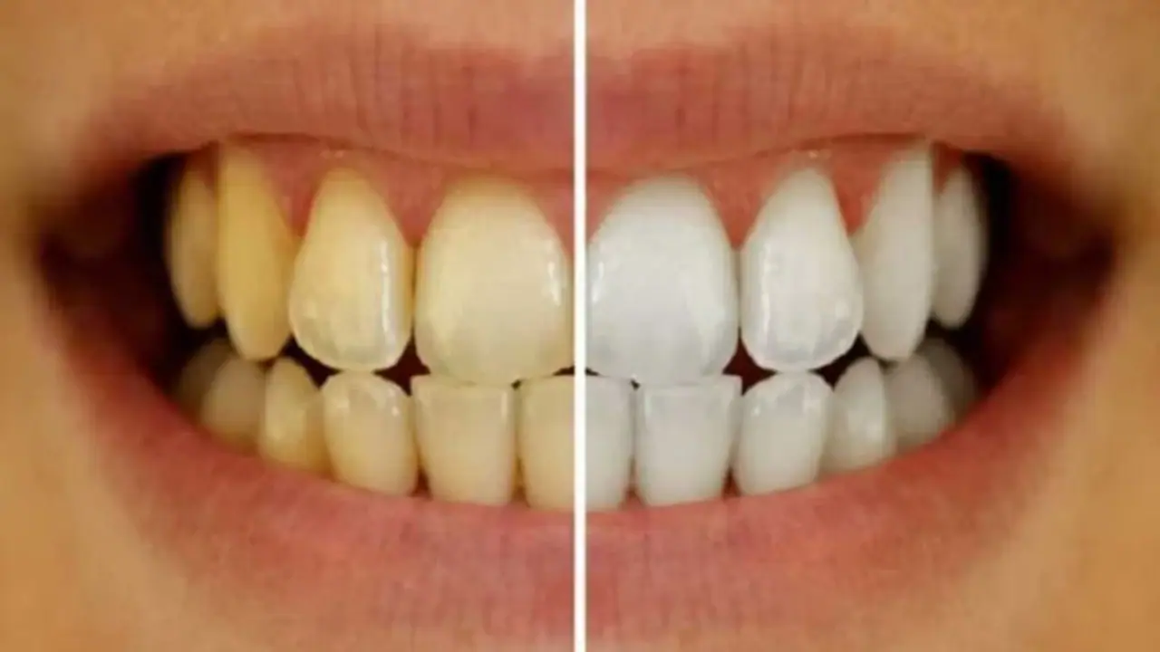 ಹಳದಿ ಹಲ್ಲನ್ನು ಬೆಳ್ಳಗಾಗಿಸಿ ಆಕರ್ಷಕ ನಗು ನಿಮ್ಮದಾಗಿಸಲು ಈ ಪುಡಿ ಬಳಸಿ