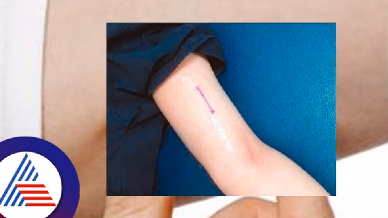 ಬಂದಿದೆ 3 ವರ್ಷ ಗರ್ಭಾಧಾರಣೆ ತಡೆವ ಇಂಪ್ಲಾಂಟ್: 4ಜಿಲ್ಲೆಗಳಲ್ಲಿ ಪ್ರಾಯೋಗಿಕ ಜಾರಿ ಬಂದಿದೆ 3 ವರ್ಷ ಗರ್ಭಾಧಾರಣೆ ತಡೆವ ಇಂಪ್ಲಾಂಟ್: 4ಜಿಲ್ಲೆಗಳಲ್ಲಿ ಪ್ರಾಯೋಗಿಕ ಜಾರಿ