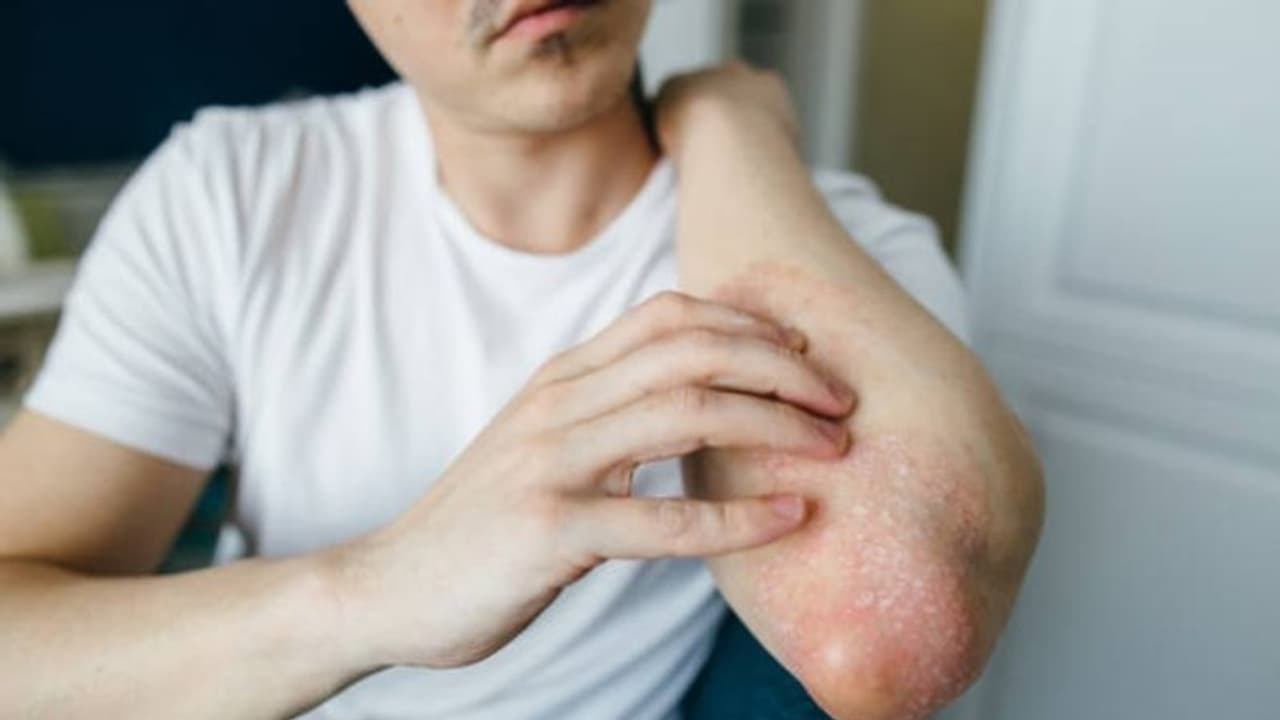 Health Tips : ചർമ്മത്തിൽ ഇടയ്ക്കിടെ വരുന്ന ചൊറിച്ചിലും തിണർപ്പും ; കാരണങ്ങൾ അറിയാം