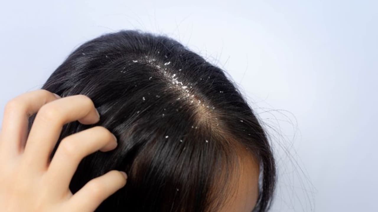 തലയില് താരൻ ഉണ്ടെങ്കില് ഇക്കാര്യങ്ങള് പ്രത്യേകം ശ്രദ്ധിക്കുക... തലയില് താരൻ ഉണ്ടെങ്കില് ഇക്കാര്യങ്ങള് പ്രത്യേകം ശ്രദ്ധിക്കുക...