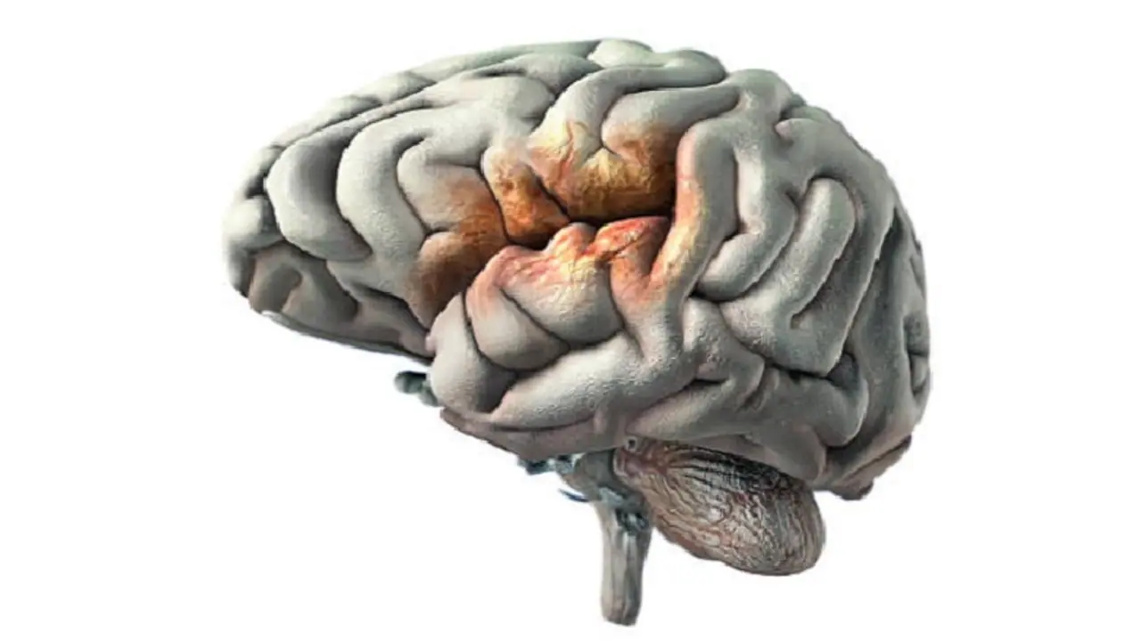 brain stroke brain stroke