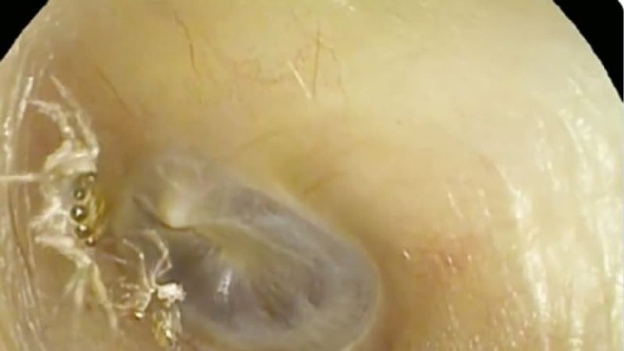 ബിപി കൂടി എത്തിയ സ്ത്രീയുടെ ചെവിക്കകത്ത് ജീവനുള്ള എട്ടുകാലി; വീഡിയോ... ബിപി കൂടി എത്തിയ സ്ത്രീയുടെ ചെവിക്കകത്ത് ജീവനുള്ള എട്ടുകാലി; വീഡിയോ...