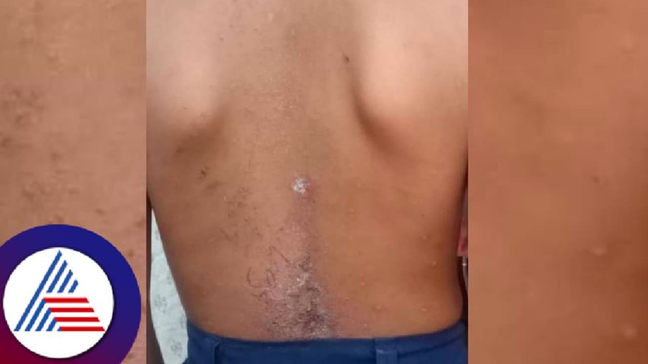 దారుణం.. ఎనిమిదేళ్ల విద్యార్థినిపై యాసిడ్ పోసిన గవర్నమెంట్ స్కూల్ హెచ్ఎం.. అసలేం జరిగిందంటే ? 