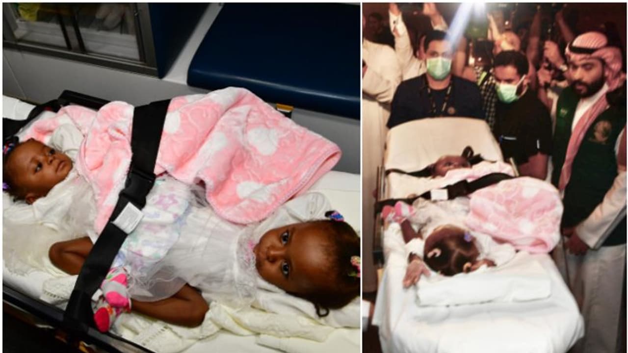 സൽമാൻ രാജാവിന്റെയും കിരീടാവകാശിയുടെയും നിര്ദ്ദേശം; ശസ്ത്രക്രിയക്കായി നൈജീരിയൻ സയാമീസ് ഇരട്ടകള് റിയാദില് സൽമാൻ രാജാവിന്റെയും കിരീടാവകാശിയുടെയും നിര്ദ്ദേശം; ശസ്ത്രക്രിയക്കായി നൈജീരിയൻ സയാമീസ് ഇരട്ടകള് റിയാദില്