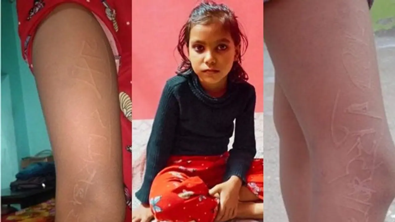 Viral: ಬಾಲಕಿಯ ಮೈಮೇಲೆ ಮೂಡುತ್ತಿದೆ ರಾಮ್, ರಾಧೆಯ ಹೆಸರು, ವೈದ್ಯಲೋಕಕ್ಕೆ ಅಚ್ಚರಿ! Viral: ಬಾಲಕಿಯ ಮೈಮೇಲೆ ಮೂಡುತ್ತಿದೆ ರಾಮ್, ರಾಧೆಯ ಹೆಸರು, ವೈದ್ಯಲೋಕಕ್ಕೆ ಅಚ್ಚರಿ!