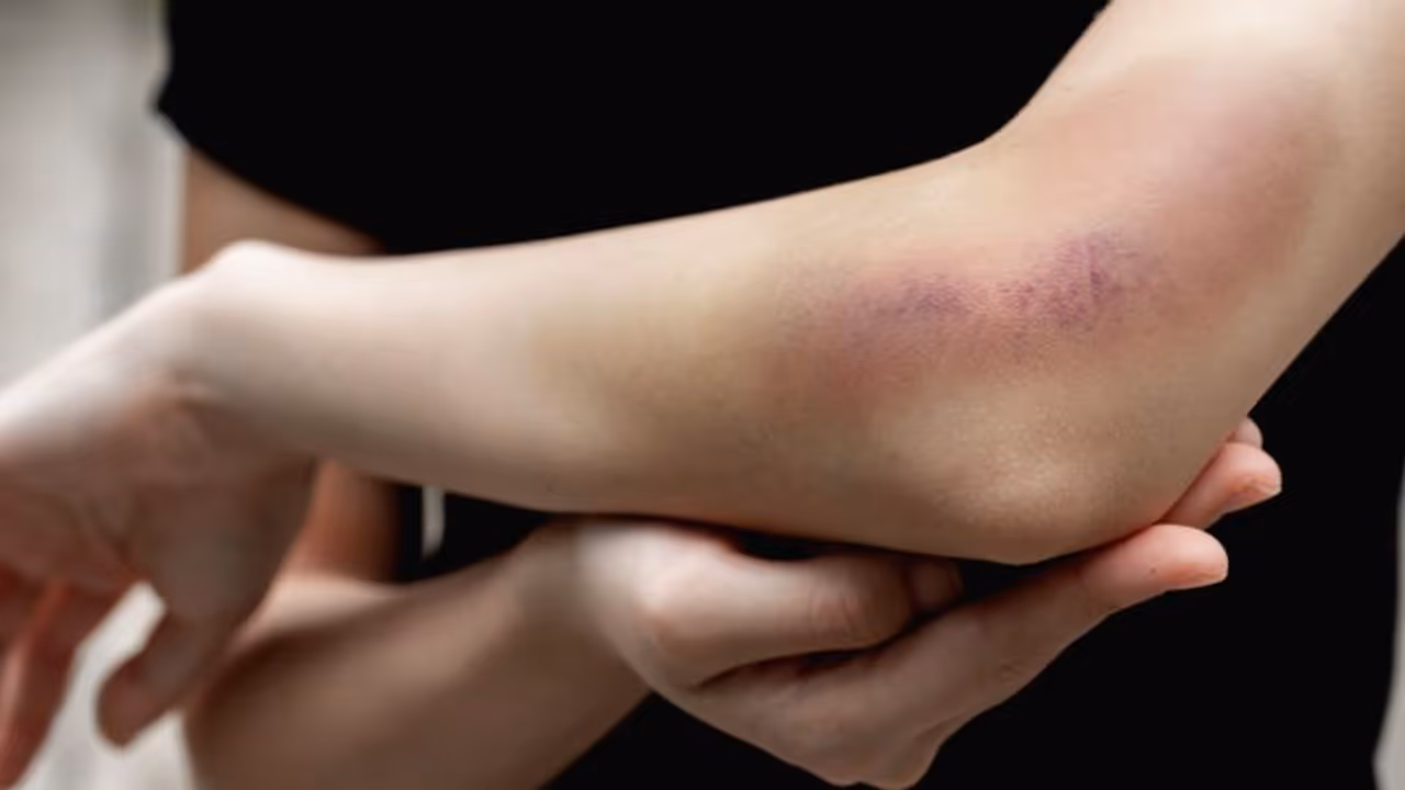 വിറ്റാമിന് കെയുടെ കുറവ്; ഈ ലക്ഷണങ്ങളെ ശ്രദ്ധിക്കാതെ പോകരുതേ... വിറ്റാമിന് കെയുടെ കുറവ്; ഈ ലക്ഷണങ്ങളെ ശ്രദ്ധിക്കാതെ പോകരുതേ...