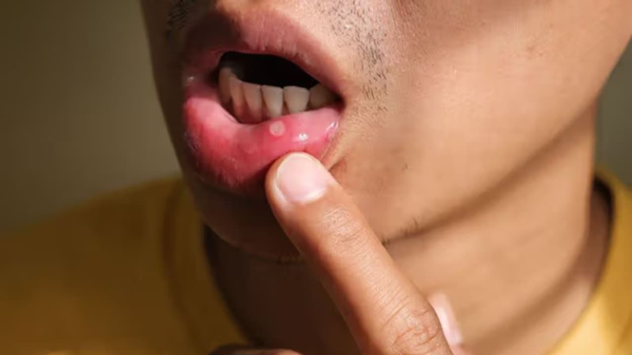 വായ്പ്പുണ്ണിന് കാരണമാകുന്ന അഞ്ച് ഭക്ഷണങ്ങൾ