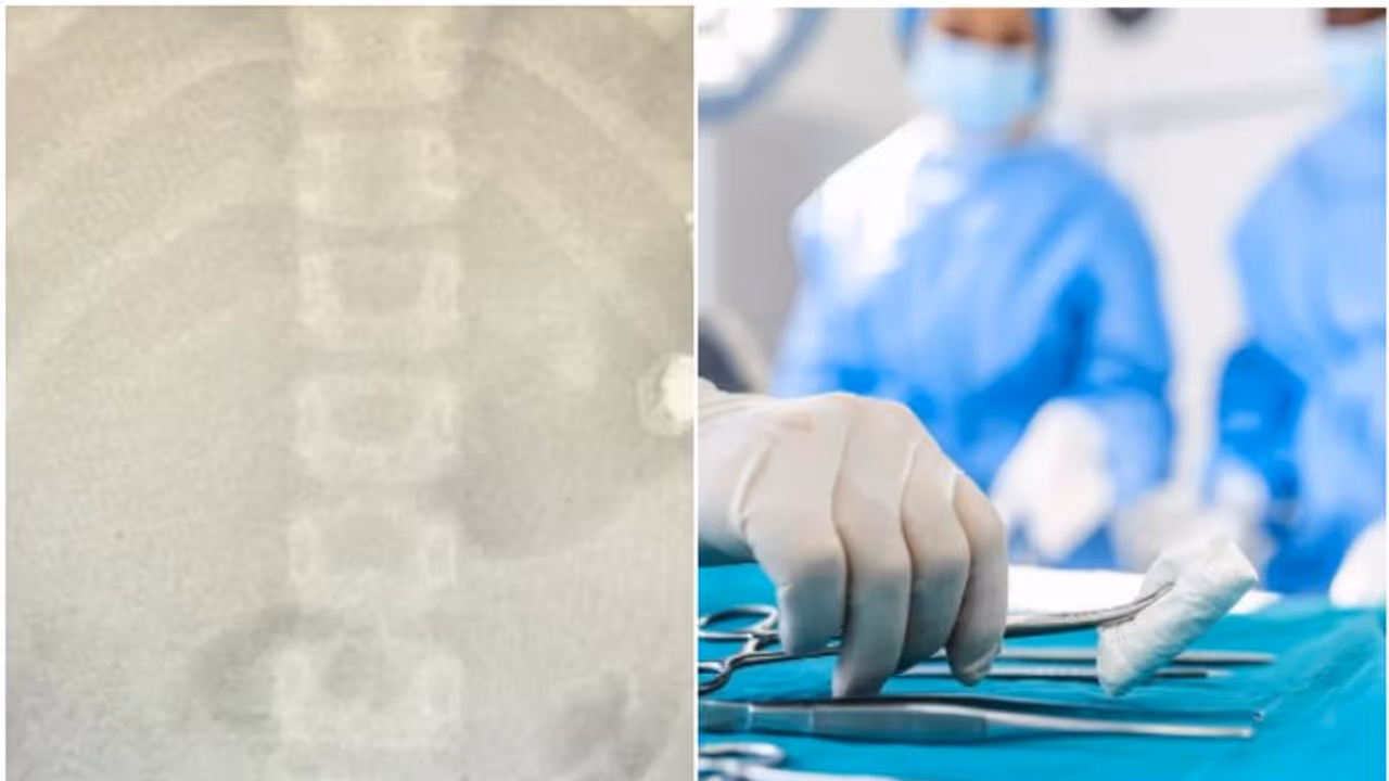 അമ്മയോട് മൊബൈല് ഫോൺ ചോദിച്ചിട്ട് കൊടുത്തില്ല, പിന്നാലെ അസ്വസ്ഥത; എക്സ്റേ, 10 വയസ്സുകാരൻ വിഴുങ്ങിയത് ഇയര് ബഡ് അമ്മയോട് മൊബൈല് ഫോൺ ചോദിച്ചിട്ട് കൊടുത്തില്ല, പിന്നാലെ അസ്വസ്ഥത; എക്സ്റേ, 10 വയസ്സുകാരൻ വിഴുങ്ങിയത് ഇയര് ബഡ്