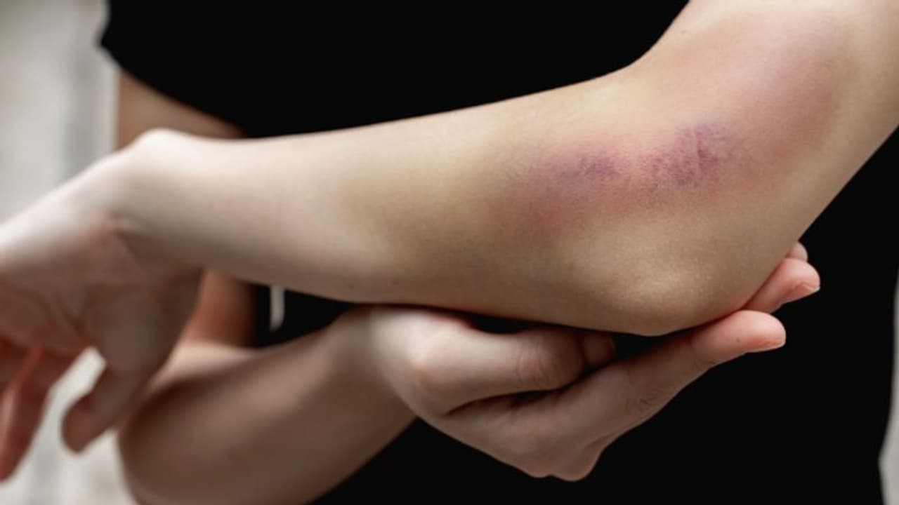 വിറ്റാമിൻ കെയുടെ കുറവ്; ശരീരം കാണിക്കുന്ന ഈ ലക്ഷണങ്ങളെ തിരിച്ചറിയാം... വിറ്റാമിൻ കെയുടെ കുറവ്; ശരീരം കാണിക്കുന്ന ഈ ലക്ഷണങ്ങളെ തിരിച്ചറിയാം...