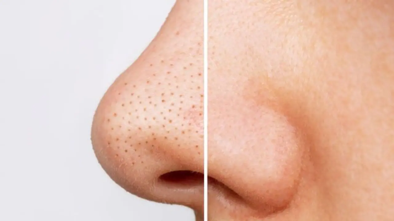 മൂക്കിന് ചുറ്റുമുള്ള ബ്ലാക്ക്ഹെഡ്സ് അകറ്റാന് വീട്ടില് പരീക്ഷിക്കാം ഈ പൊടിക്കൈകള്... മൂക്കിന് ചുറ്റുമുള്ള ബ്ലാക്ക്ഹെഡ്സ് അകറ്റാന് വീട്ടില് പരീക്ഷിക്കാം ഈ പൊടിക്കൈകള്...