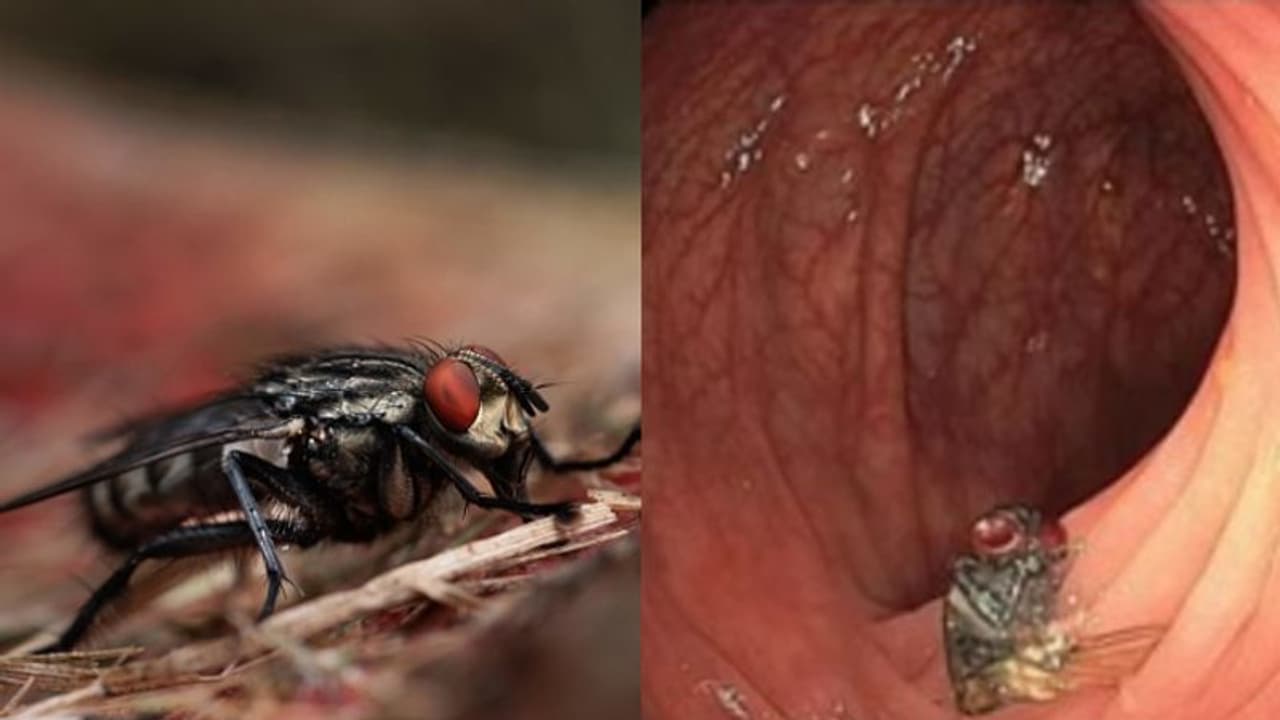 63കാരന്‍റെ വൻകുടലിന്‍റെ ഭിത്തിയിൽ പരിക്കുകളില്ലാതെ ഈച്ച, അമ്പരന്ന് ആരോഗ്യ വിദഗ്ധർ