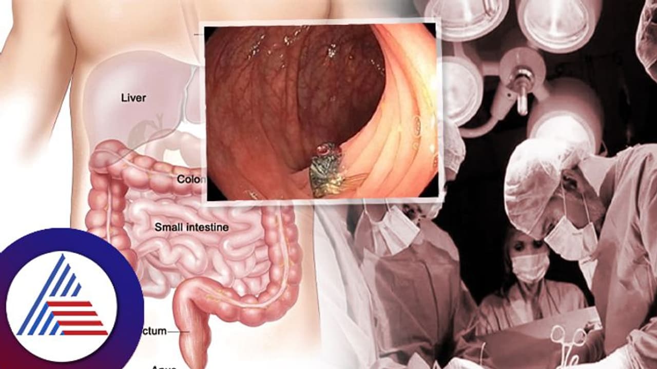 ಹೋಗಿದ್ದು ಕ್ಯಾನ್ಸರ್ ಪರೀಕ್ಷೆಗೆ, ಹೊಟ್ಟೇಲಿದ್ದ ಜೀವಂತ ಕೀಟ ನೋಡಿ ಡಾಕ್ಟರ್ಸ್ ಶಾಕ್! ಹೋಗಿದ್ದು ಕ್ಯಾನ್ಸರ್ ಪರೀಕ್ಷೆಗೆ, ಹೊಟ್ಟೇಲಿದ್ದ ಜೀವಂತ ಕೀಟ ನೋಡಿ ಡಾಕ್ಟರ್ಸ್ ಶಾಕ್!