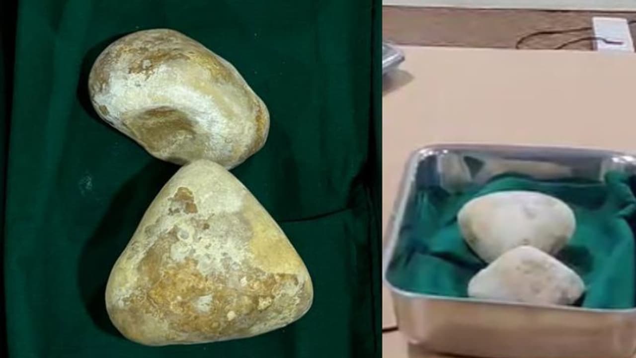 ഓച്ചിറ സ്വദേശി എത്തിയത് അടിവയര് വേദനയുമായി; സ്കാനിൽ കണ്ടത് അര കിലോയുള്ള കല്ല്, 1 മണിക്കൂര് ശസ്ത്രക്രിയ ഓച്ചിറ സ്വദേശി എത്തിയത് അടിവയര് വേദനയുമായി; സ്കാനിൽ കണ്ടത് അര കിലോയുള്ള കല്ല്, 1 മണിക്കൂര് ശസ്ത്രക്രിയ