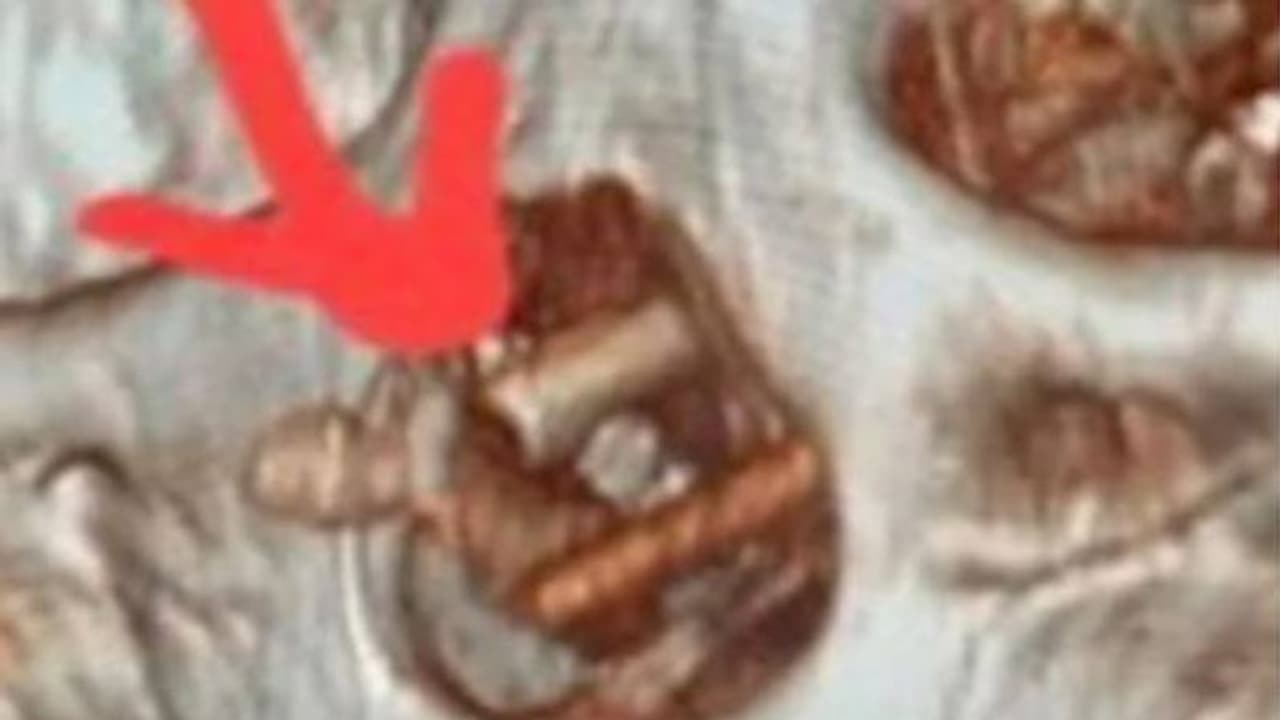 അഞ്ചുമാസമായി കടുത്ത തലവേദന, തലച്ചോറിൽ കയറിയ വസ്തു കണ്ട് ഞെട്ടി രോ​ഗിയും ഡോക്ടർമാരും