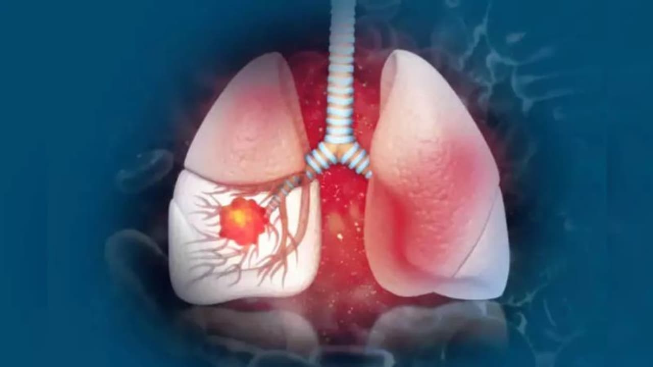 വൈറ്റ് ലങ് സിൻഡ്രോം; അറിഞ്ഞിരിക്കാം ഈ ലക്ഷണങ്ങളെ... വൈറ്റ് ലങ് സിൻഡ്രോം; അറിഞ്ഞിരിക്കാം ഈ ലക്ഷണങ്ങളെ...