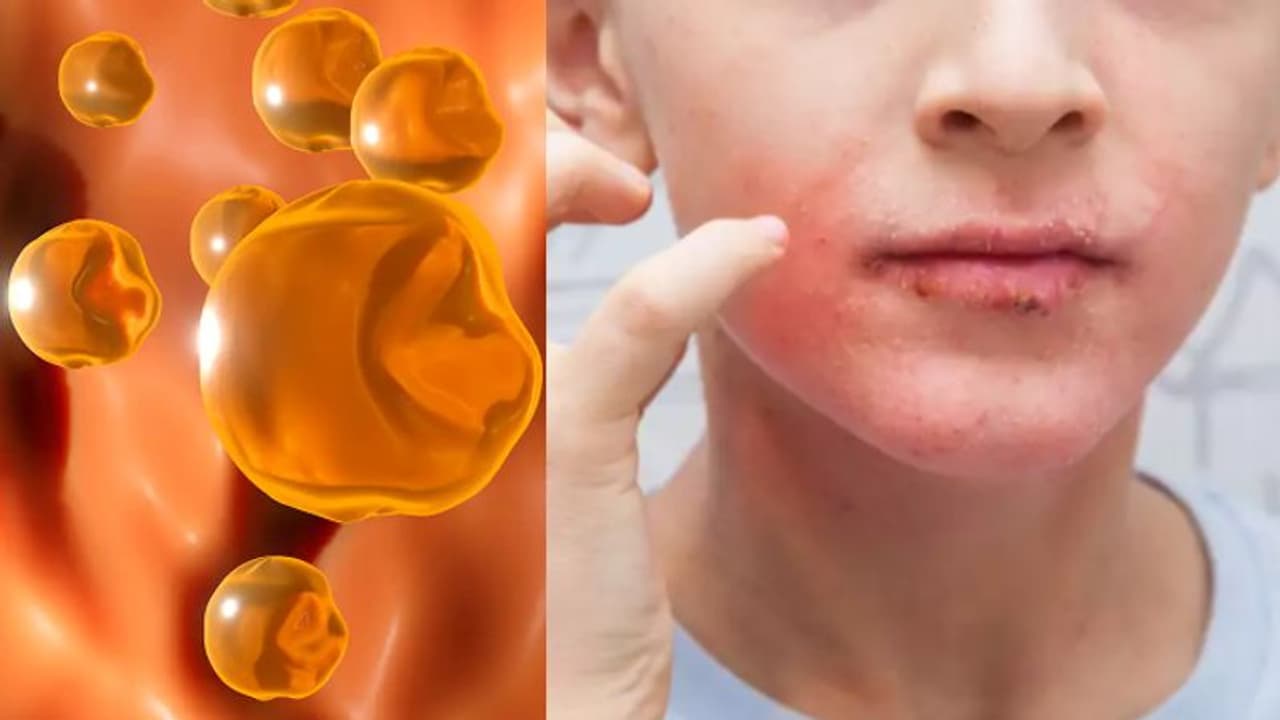 Health Tips: ചീത്ത കൊളസ്‌ട്രോള്‍ ഉണ്ടോ? മുഖത്ത് പ്രകടമാകുന്ന ഈ ലക്ഷണങ്ങളെ തിരിച്ചറിയാം... 