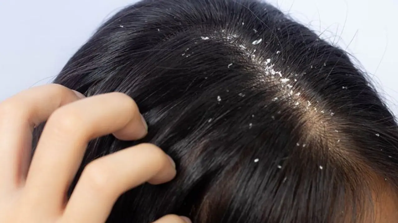 താരനെ അകറ്റാന് അടുക്കളയിലുണ്ട് വഴികള്... താരനെ അകറ്റാന് അടുക്കളയിലുണ്ട് വഴികള്...