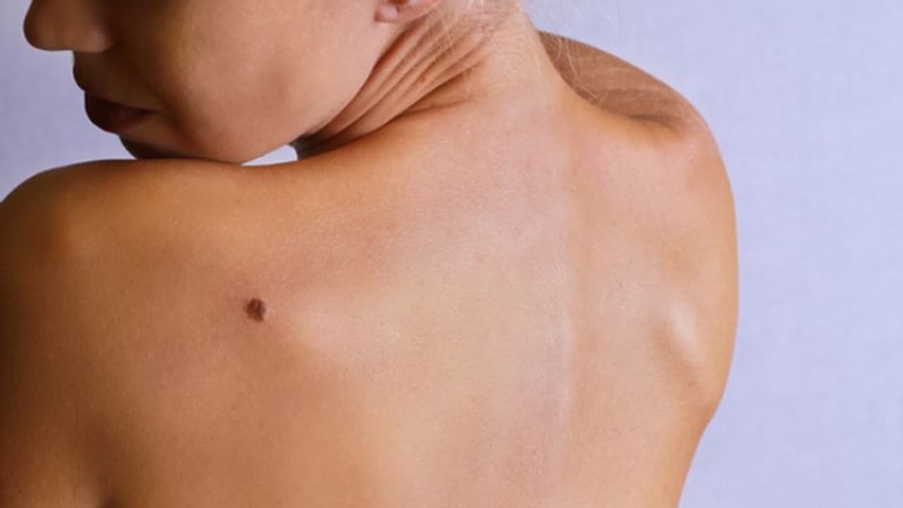 മെലനോമ; തിരിച്ചറിയാം ഈ ലക്ഷണങ്ങളെ... 