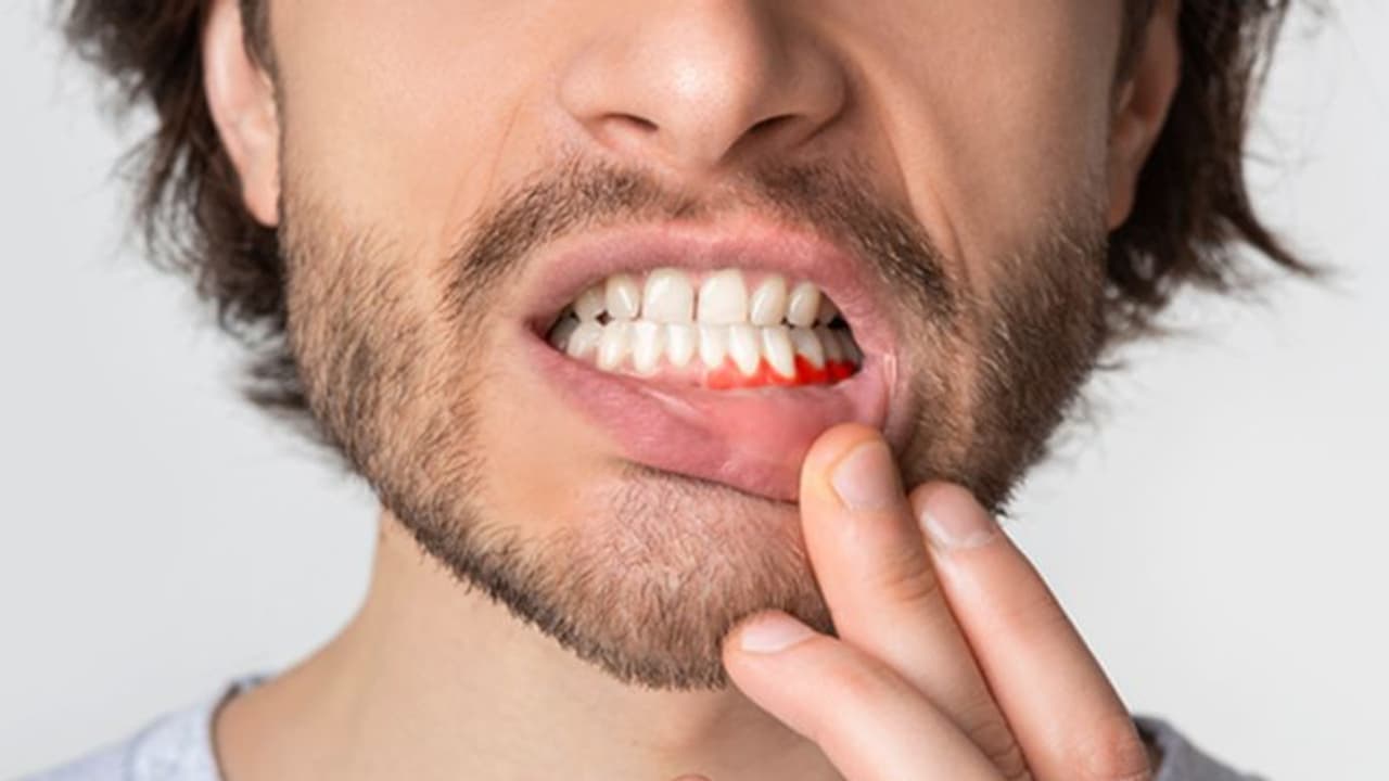 മോണരോഗത്തെ എങ്ങനെ തിരിച്ചറിയാം? ശ്രദ്ധിക്കേണ്ട കാര്യങ്ങള്... മോണരോഗത്തെ എങ്ങനെ തിരിച്ചറിയാം? ശ്രദ്ധിക്കേണ്ട കാര്യങ്ങള്...