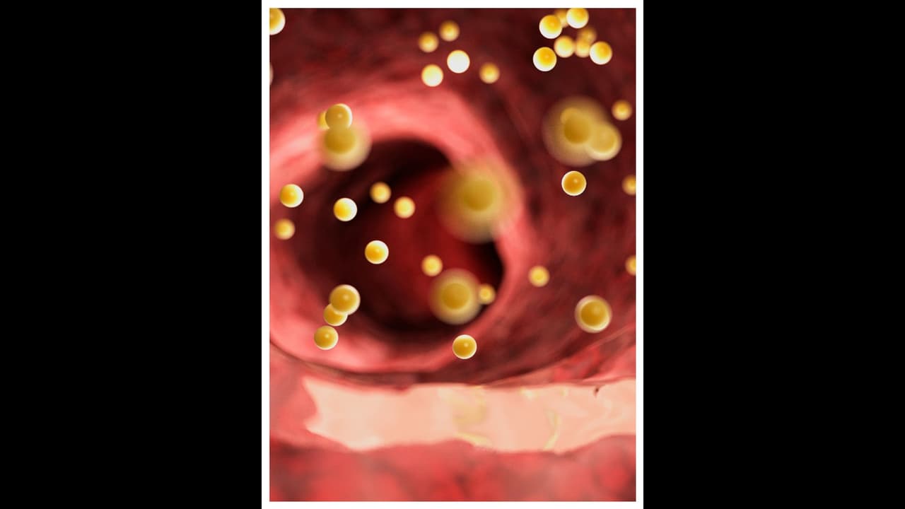 ഈ ചേരുവ മതി, ചീത്ത കൊളസ്ട്രോൾ ഈസിയായി കുറയ്ക്കാം 