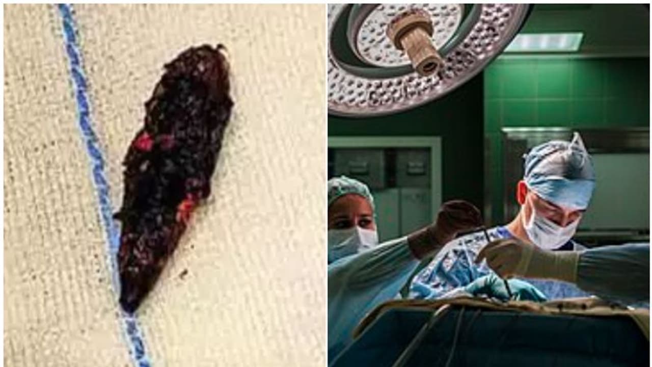 തലയ്ക്കകത്ത് വെടിയുണ്ടയുമായി 18 വർഷം ജീവിതം, ഒടുവിൽ വിദേശ യുവാവിന് ബെം​ഗളൂരുവിൽ ആശ്വാസം, ശസ്ത്രക്രിയ വിജയം!