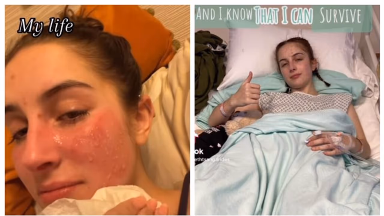 'ജീവനോടെ ചുടുന്നത് പോലെ'; അലര്‍ജി രോഗം കാരണം ചിരിക്കാനോ കാരയാനോ പറ്റാതെ 20 കാരി !