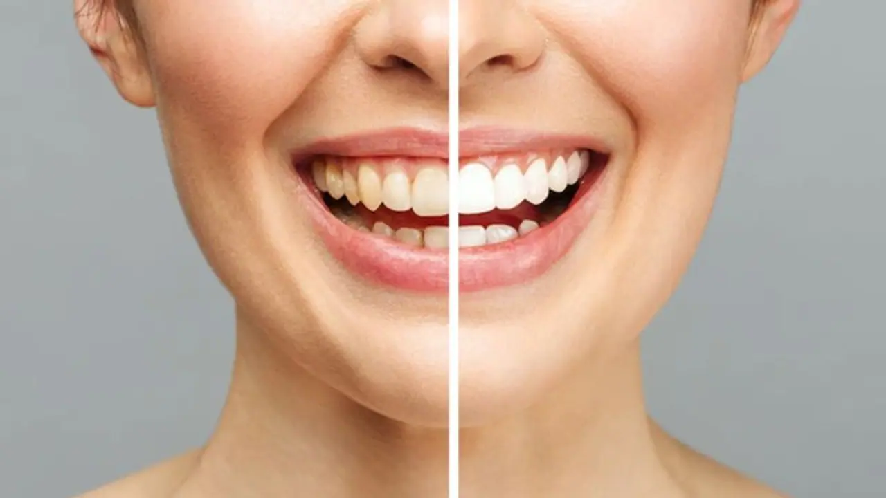 പല്ലിലെ കറ മാറ്റാന്‍ പരീക്ഷിക്കാം ഈ അഞ്ച് വഴികള്‍...